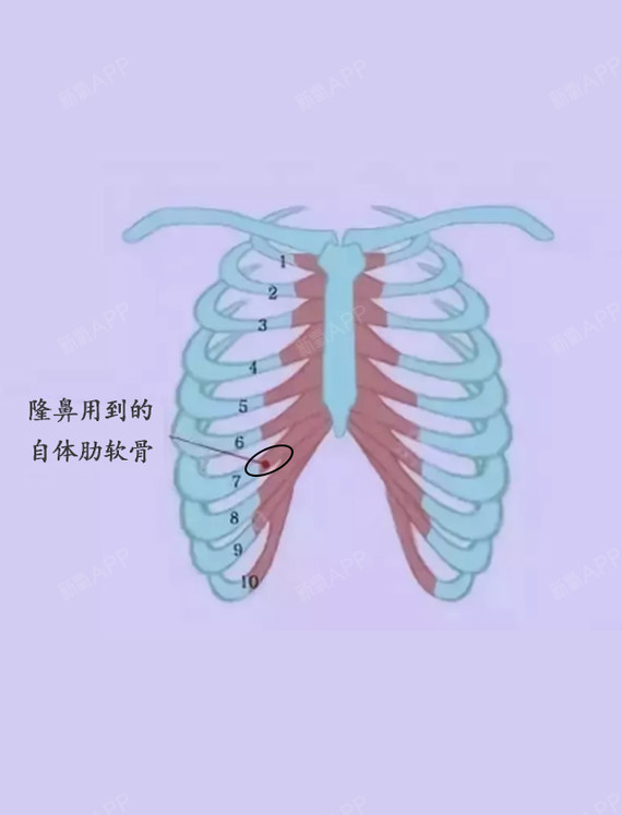 肋软骨隆鼻会变形?