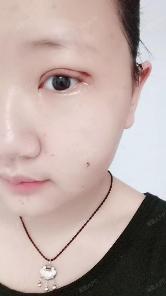 这是术后第二天～我真的有在很认真的记录我做完双眼皮后的每一天!