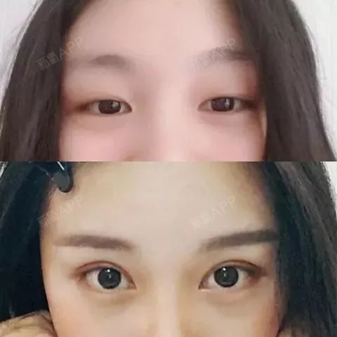 [:84]做双眼皮到底开不开眼角?这些建议很实用!_圈子-新氧美容整形