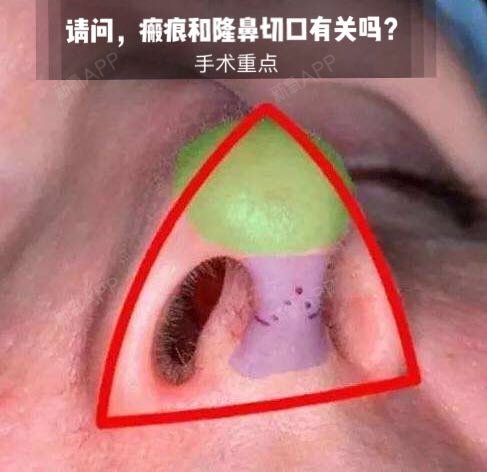 怎样选择隆鼻切口瘢痕才不明显?