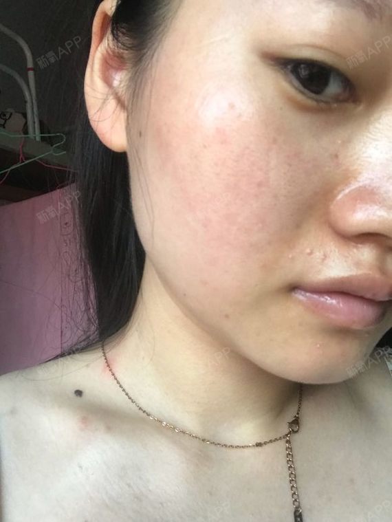 南京激光祛红血丝好不好_效果图_氧气y8s6r激光祛红血丝术后第65天