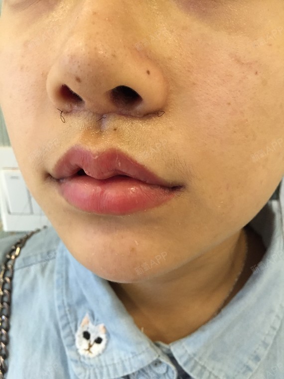 唇部综合好不好_效果图_氧气y5xdp唇部综合术后第7天_新氧美容整形