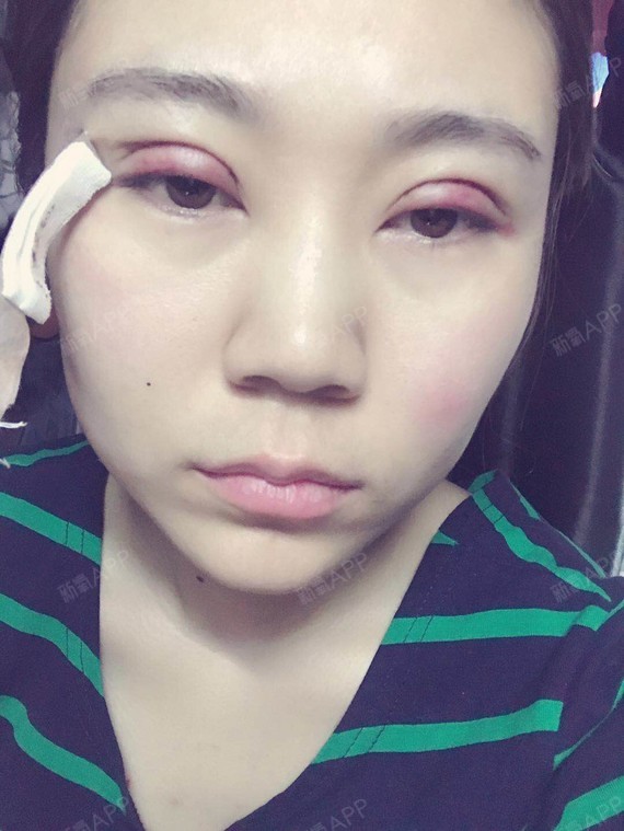 安安anan眼部综合第3天美丽日记