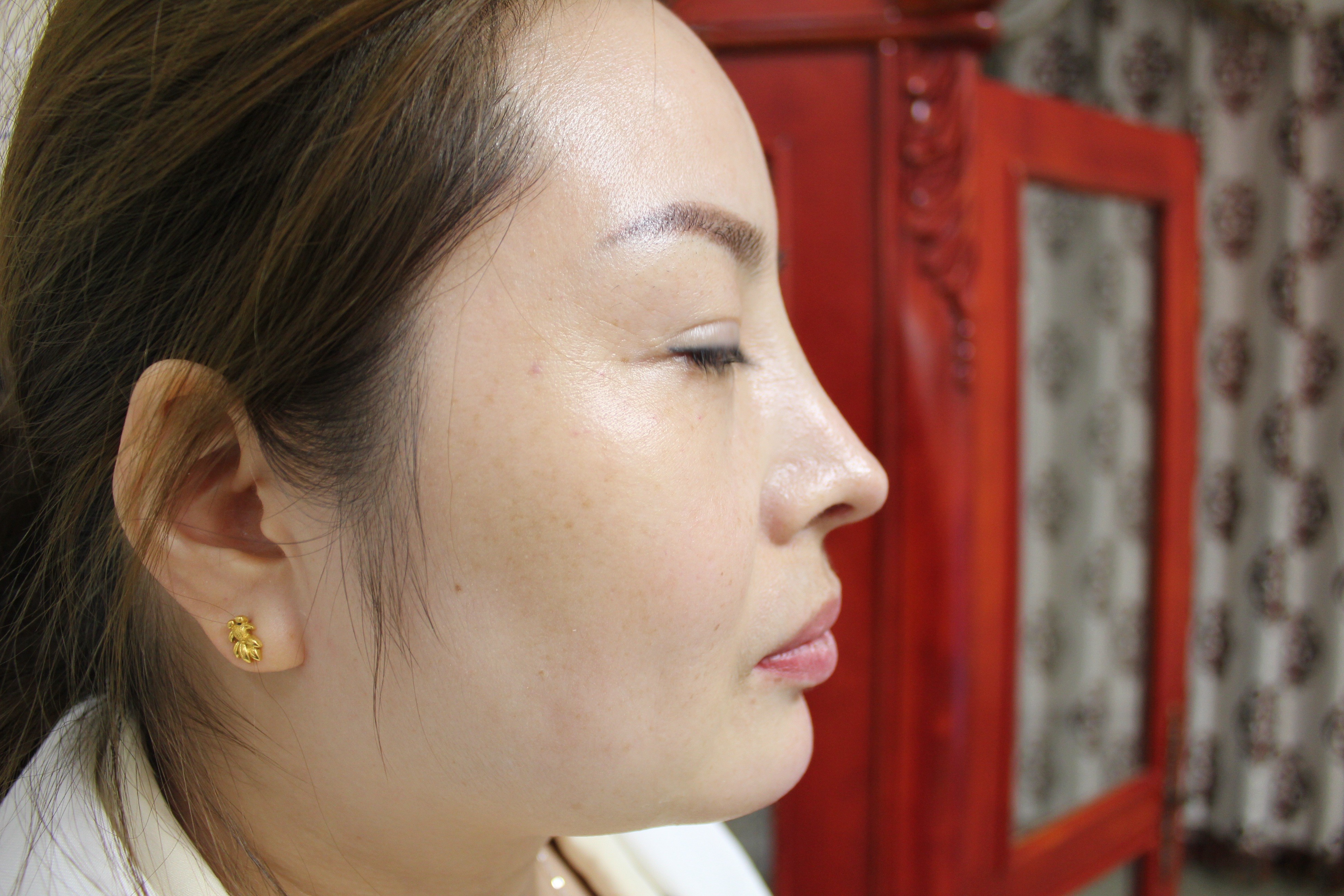 玻尿酸垫下巴第1天