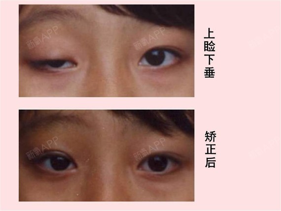 【科普】什么是上睑下垂?看了你就知道了!