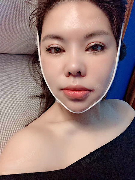 双鄂,轮廓四件套手术10天,再次去医院复查做消肿的_圈子-新氧美容整形