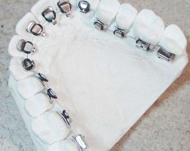 接下来只要等拔牙的伤口愈合,就可以预约去粘托槽佩戴矫正器