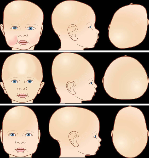 婴儿脑积水头型图片图片