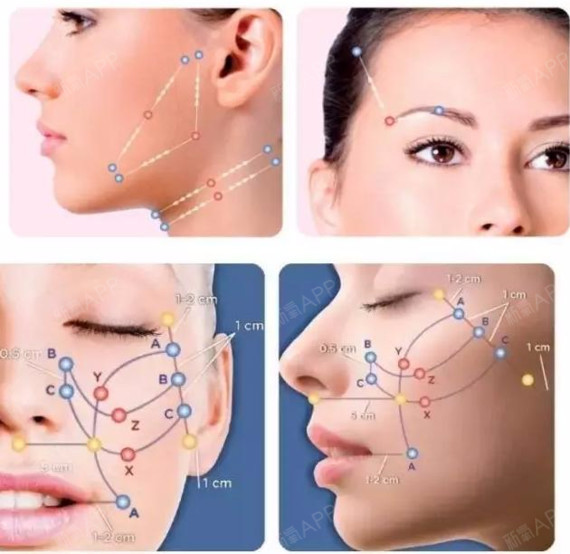 线雕大v和小v的区别,你一定要收藏的线雕提升干货?_圈子-新氧美容整形