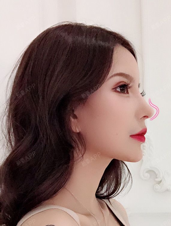 鼻翼整形的干货分享,你真的适合做外切吗?