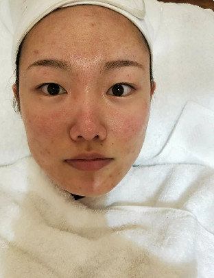 莲姿娜(北京国贸店)光子嫩肤怎么样_恢复过程_效果如何_熙风k整形日记