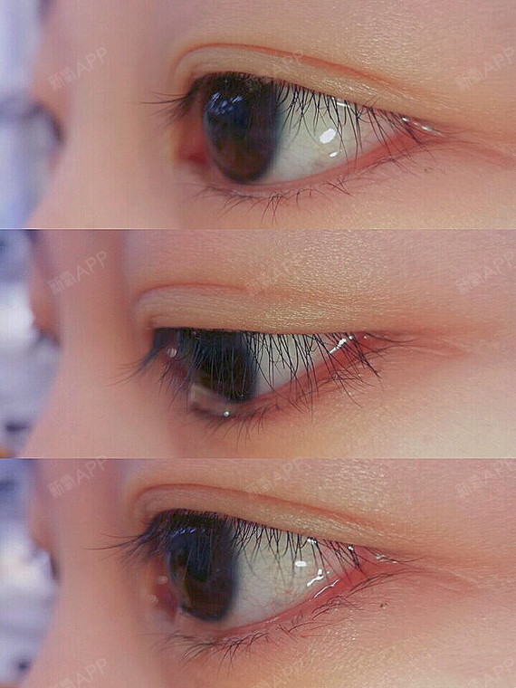 玩手机、看电脑眼睛干痒,滴眼药水OK吗?随着