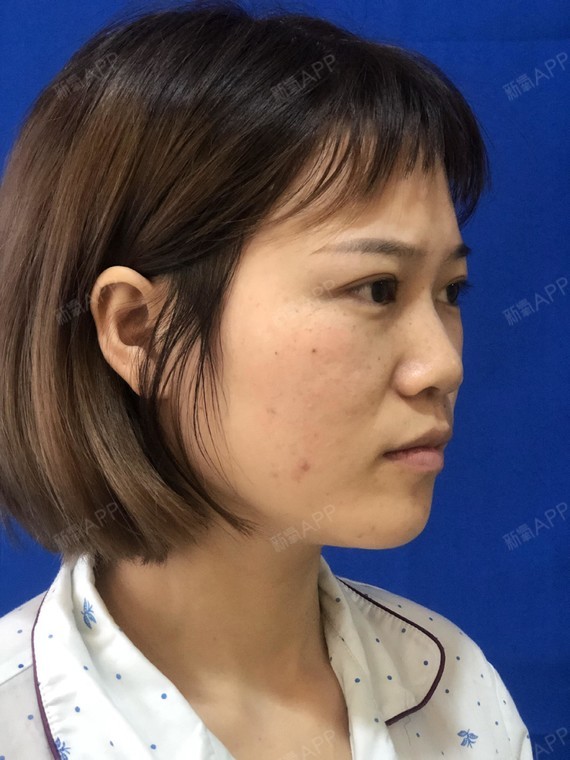 你是真的爱我吗自体软骨垫鼻尖第0天美丽日记