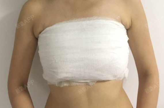 【曼托尊贵版毛面水滴假体隆胸 脂肪填充边缘】匿了三_圈子-新氧美容