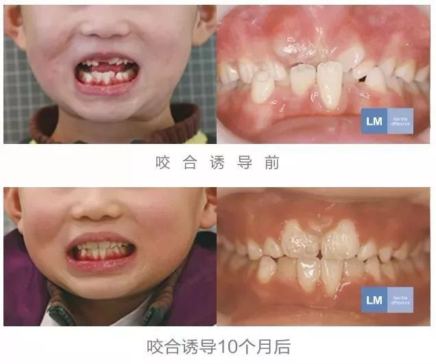 别让你的疏忽,错过小朋友面型最佳矫正时间