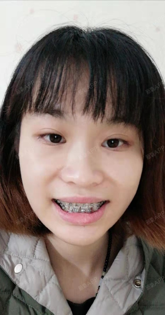 25开始戴牙套的,已经很久没有更新日记了嘿_圈子-新氧美容整形