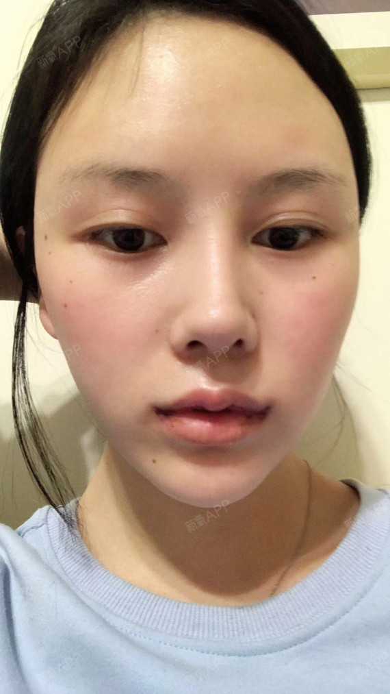 致臻爱微笑唇第三天.