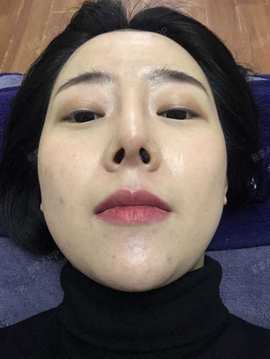 鼻综合