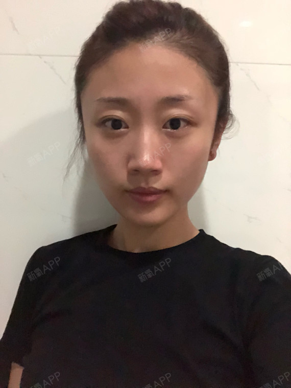 术前我是这样的鼻子短短塌塌平平的鼻子让脸看起来显大整张脸都没有