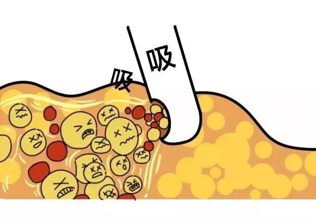 春季吸脂必看