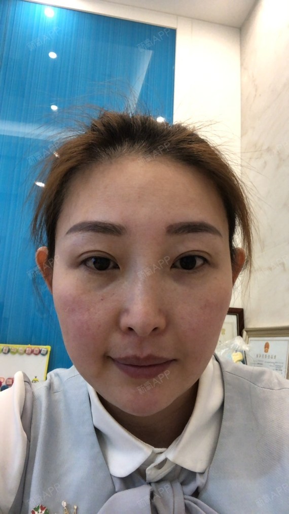 北京玻尿酸丰泪沟好不好_效果图_氧气zv2so玻尿酸丰泪沟术后第7天