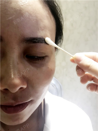 半永久纹眉项目术后第3天      今天结的痂开始脱落,有一点痒痒的