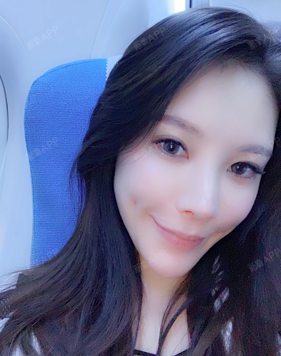 酒窝成形术好不好_效果图_小小de酒窝酒窝成形术术后第0天_新氧美容