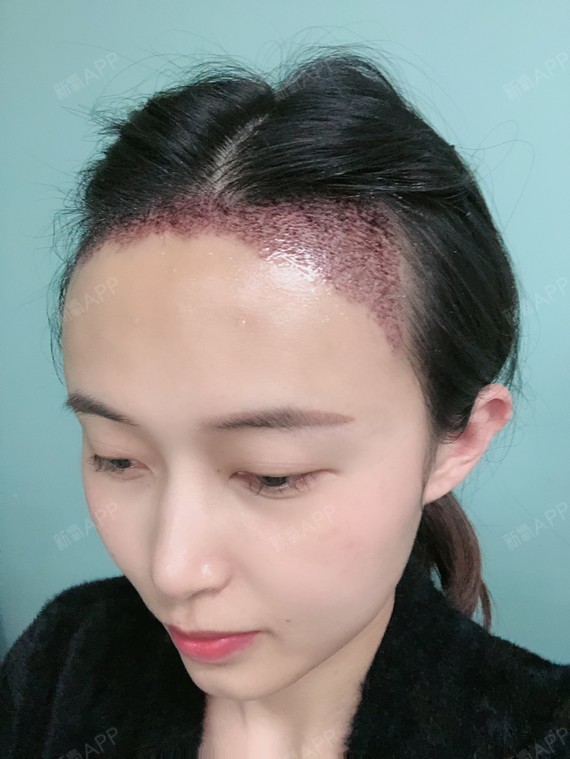 发际线植发第三天发际线位置开始结痂了以前2天没洗头就受不了现在第