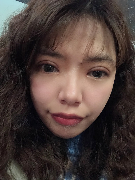 满月啦[:153]今天是做双眼皮的术后一个月了[:_圈子-新氧美容整形