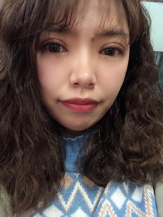 满月啦[:153]今天是做双眼皮的术后一个月了[:_圈子-新氧美容整形