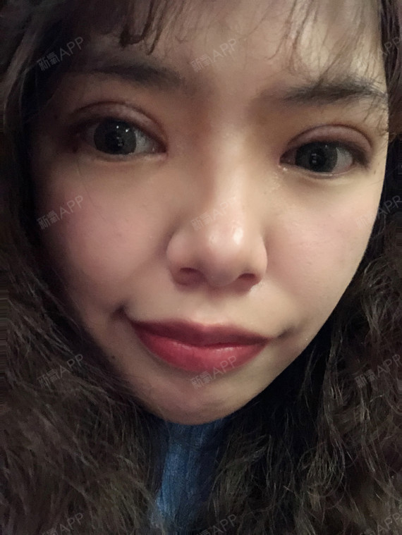 满月啦[:153]今天是做双眼皮的术后一个月了[:_圈子-新氧美容整形