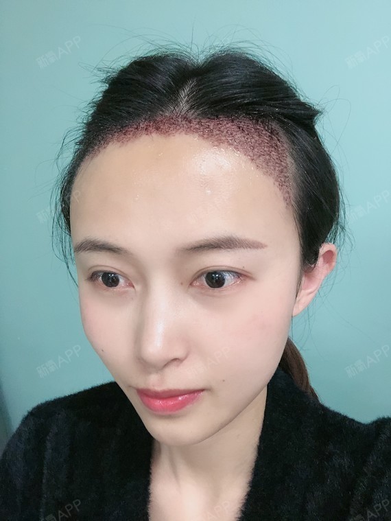 发际线植发第三天发际线位置开始结痂了以前2天没洗头就受不了现在第