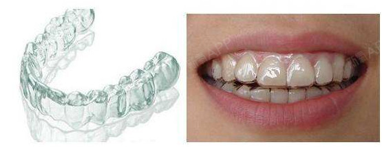 像塑料一样的隐形牙套,效果真的好吗?