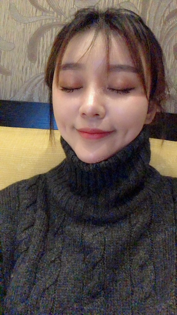 氧气px0366b酒窝成形术第16天美丽日记-新氧美容整形