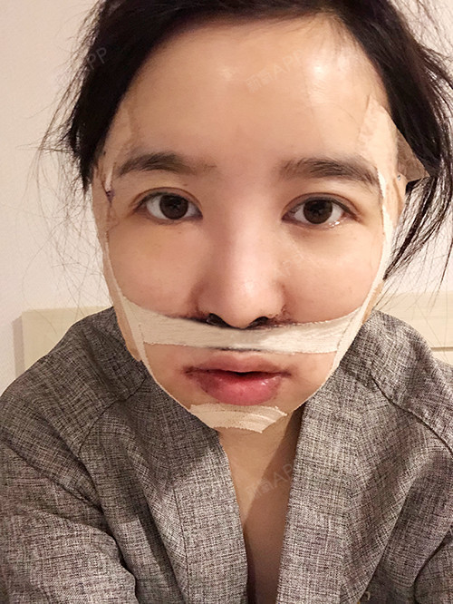 上颚前突/天包地好不好_效果图_缺氧乖张7上颚前突/天包地术后第1天