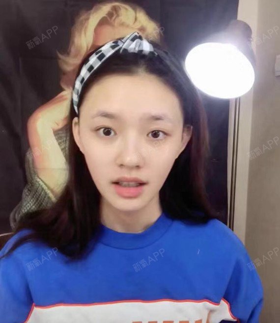 [:94]做完双眼皮却还是双目无神?你忽略了这个_圈子-新氧美容整形