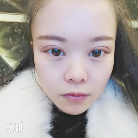 双眼皮一个月了,亲们帮忙看看有没有变化.