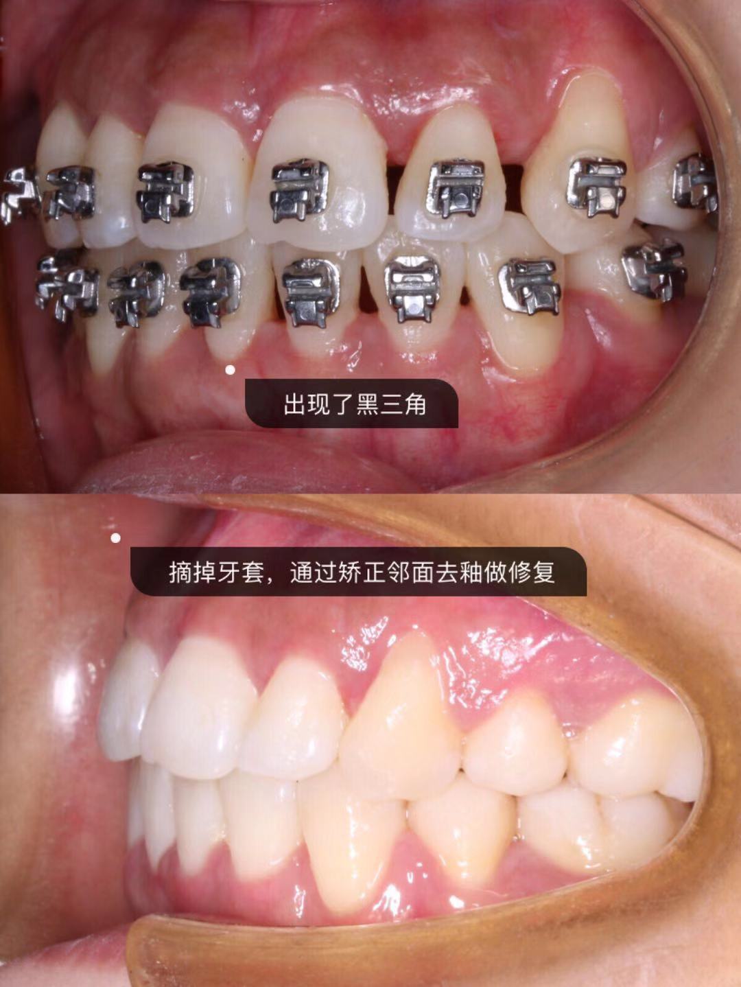 牙齿的黑三角到底有多可怕60可能还没几个人知道60