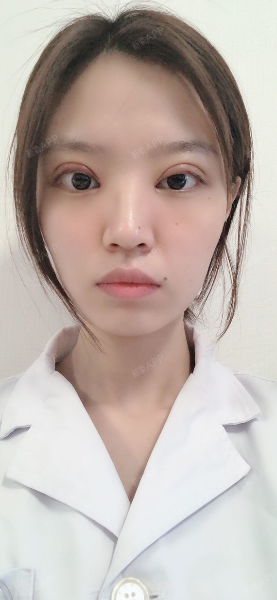 做完双眼皮已经快一周了,这一周我想了很多眼睛恢复以_圈子-新氧美容