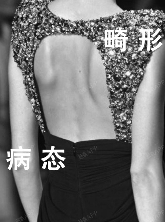 别再迷信蝴蝶骨这种畸形审美了,这是病,得治疗!