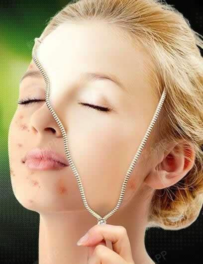 激光祛痘祛痘印