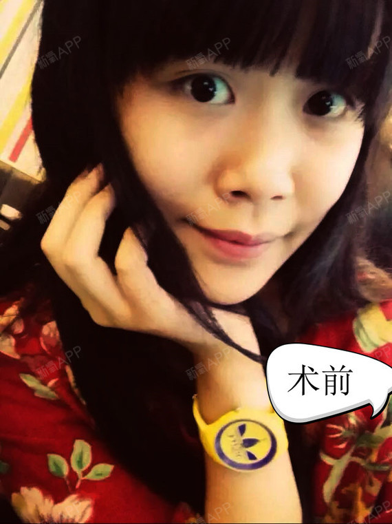 隆鼻手术切口开在哪里更隐蔽?如何避免术后疤