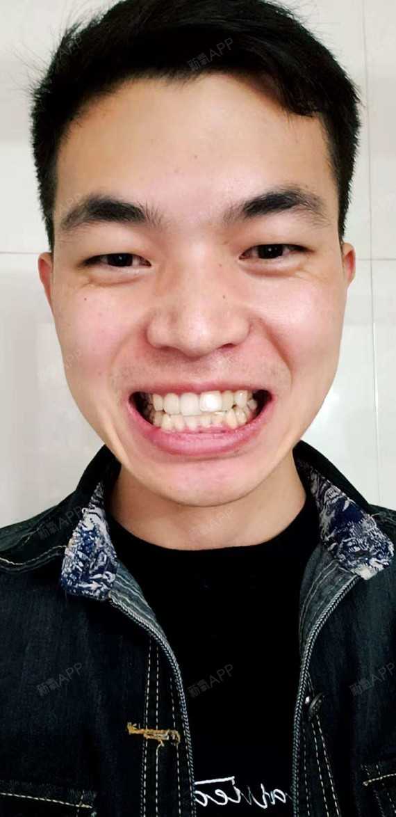 上海隐形矫正好不好_效果图_机器猫的谷故事隐形矫正术后第3天_新氧