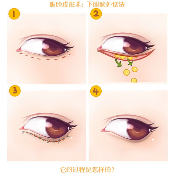 下眼睑手术(选择1): 外切法