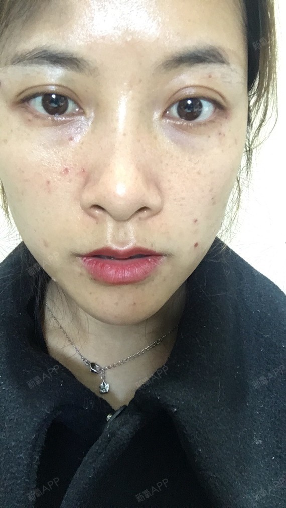 昆明激光点痣好不好_效果图_小朵花儿激光点痣术后第1天_新氧美容整形