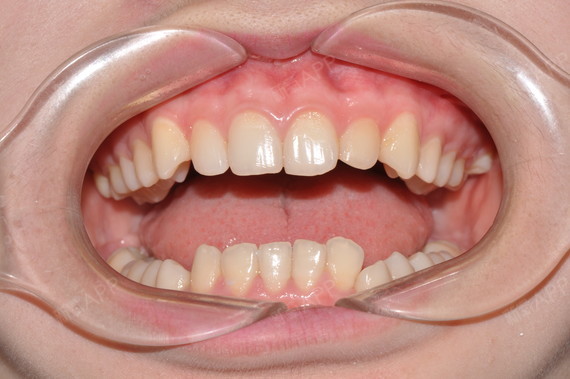 先说一下我的牙齿情况吧,我的牙齿深覆合,咬合关系不_圈子-新氧美容