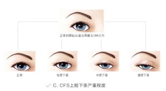 切眉要多久恢复?别让眉毛影响了你的风水,懂吗