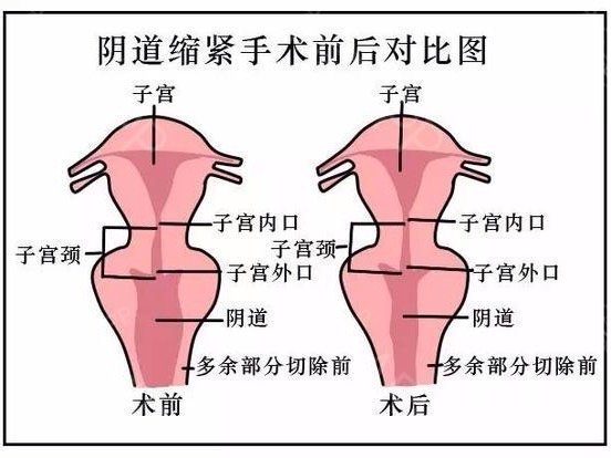 首页 此页面仅支持预览 Avatar 李凡 13篇日记 阴道口有块肉 子宫 掉到体外 这是经常有人咨询我的问题很多40岁以上或顺产后的女性自己觉得阴道松弛 时间一长发现自己的阴道口有块肉却不知是什么原因 其实 这极有可能是子宫脱垂 能看到的那块肉极有