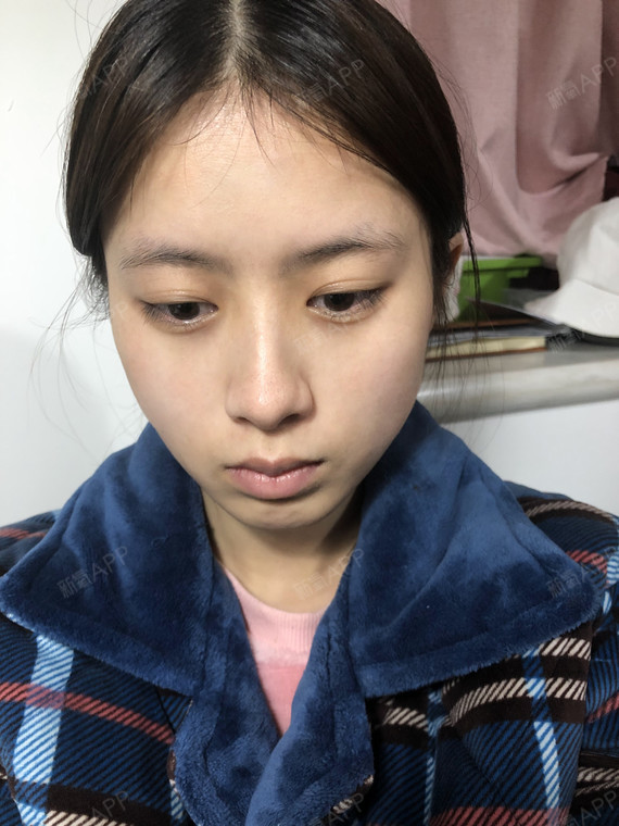 可以回家睡觉激光祛斑第16天美丽日记-新氧美