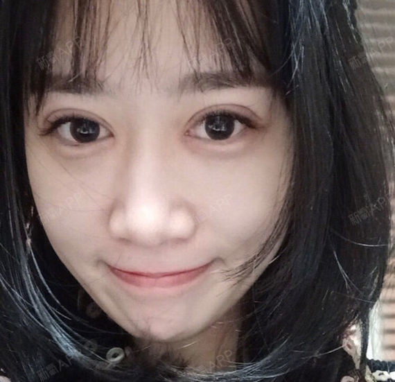 闺蜜说双眼皮有点宽了,我个人觉得还好,主要我喜欢两边是对称